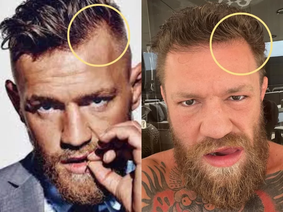 Conor McGregors Hairline: Is He Going Bald or Not?